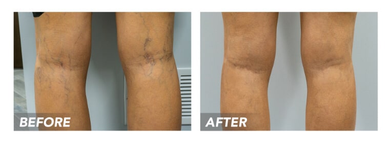 The internet is often the first place we go to look for answers, especially when it comes to our health. If you are looking for ways to get rid of your spider veins or varicose veins, Dr. Google probably recommended a litany of at-home remedies, but none of them really did the trick. Dr. Let’s dig deeper into some of the most common “remedies” floating around on the web to understand why they didn’t help and how they can actually make your conditions worse. H2: Essential Oils Essential oils have risen in popularity and accessibility, as they are extremely versatile. They can help with aromatherapy, cuts and scrapes, cleaning, and can alleviate some of the pain and discomfort associated with spider veins and varicose veins. However, this is only a temporary effect, and some experts believe this relief may even be due to the placebo effect. Although they may seem harmless and all-natural, they can sometimes do more harm than good because of their potency and concentration. The skin around varicose veins is quite thin and tender, so using essential oils in high concentrations on these fragile areas can lead to many symptoms of allergic reactions, including rashes, irritation, skin inflammation, hives, and shortness of breath. H2: Apple Cider Vinegar and Witch Hazel In the last decade, apple cider vinegar, also known as ACV, has made waves in holistic health for being nature’s cure for almost anything, including pain, swelling, digestive blocks, and metabolic issues. There is no proven research showing that apple cider vinegar can treat varicose veins, but there are many unfounded claims that dipping gauze in apple cider vinegar and putting it on the veins can help the swelling go down. However, there is no known benefit to applying ACV to the skin. Another popular natural remedy is witch hazel, a yellow-flowered shrub that is said to decrease inflammation or strengthen blood vessels, which theoretically would help heal spider veins or varicose veins. But witch hazel, similar to apple cider vinegar, does not have any scientific research backing up these claims. In fact, there is no ingestible root, fruit, or herb that can completely cure spider veins or varicose veins, because only medical treatment from an experienced vein doctor at a vein treatment center can do that. CONTENT BLOCK #1 CTA link: https://www.veintreatmentclinic.com/vein-treatments/ CONTENT BLOCK #2: Promote Blood Circulation with Food There are still some ways to adjust your diet to keep your vein disease from progressing further, even if they don’t provide a definitive cure. You can implement these tips both before and after your medical treatment at a spider vein center. H2: Taste the Rainbow A great way to ensure that you are getting all of the essential vitamins, minerals, and other nutrients that your body needs is by including an array of colorful fruits and vegetables in your diet. Try to eat your fruits and vegetables raw whenever possible to reduce inflammation and encourage blood flow, because a lot of beneficial vitamins and nutrients get lost in the cooking process. Choosing fruits and vegetables that are high in fiber can help soften your stools and promote bowel movement, which can help you avoid constipation that can increase pressure on your veins. Having some healthy options prepped in your refrigerator, like cut fruit or a leafy salad will do wonders for your nutrition and overall health. H2: Manage Salt Levels While salt is definitely important for your body to function at its best, it is important to keep everything in moderation.Cut down on your consumption of foods that are high in salt, like pickled and canned goods for example. Regulating your salt intake alleviates water retention, which lowers blood pressure and promotes healthy blood flow, thus preventing vein disease from progressing. Limiting salty foods in your diet coupled with drinking lots of water to help your body flush out extra salts can lower blood pressure in your veins. CONTENT BLOCK #2 CTA link: https://www.veintreatmentclinic.com/vein-diseases/ CONTENT BLOCK #3: Minimally-Invasive Treatment from a Vein Doctor H2: Minimally-Invasive Treatment These dietary recommendations can help prevent vein disease from worsening, but the only true cure is a minimally-invasive procedure performed by a vein doctor. For visible spider vein treatment, sclerotherapy involves tiny needles to inject medicine that significantly improves the appearance of spider veins in just one month. Saphenous veins that cause varicose veins can be targeted using VenaSeal, radiofrequency ablation, or varithena. VenaSeal is a new FDA-approved vein adhesive used to close the saphenous vein in the leg that causes varicose veins. Radiofrequency ablation uses heat energy to close down the walls of the damaged vein. Varithena is a sclerotherapy foam injected into the damaged vein to reduce the appearance and symptoms of varicose veins. All of these treatment options take less than a half-hour and cause minimal discomfort. You can go home or back to work after the procedure at the vein treatment clinic because there is no anesthesia or recovery time involved. H2: Find a Vein Doctor NYC! If you have spider veins or varicose veins, and need to determine if you have a vein disease, it is essential to set up an appointment with a vein specialist in venous medicine to minimize damage to the veins and prevent further problems down the road. If you are looking for a “vein doctor NYC,” you can contact us at the Vein Treatment Clinic location in New York City, conveniently located in the heart of New York in Midtown, near notable landmarks such as Hudson Yard and Bryant Park. Our vein treatment center is easily accessible, as it is in close vicinity to both Grand Central Station and Penn Station. You can schedule your consultation with any of our three incredible vein doctors and be assured of the highest-quality care. Dr. Sareh Rajaee is a Yale-trained vascular surgeon with extensive experience in vein and arterial disease. Dr. Namrata Khimani is a double board-certified doctor who trained at both Harvard and Columbia, and her expertise is in recurrent vein disease and patients who have had prior procedures. Dr. Juan Montoya is a Yale-trained double board-certified specialist in venous medicine and cardiothoracic surgery, and is bilingual in English and Spanish. They all prioritize patient care and strive to provide treatment with compassion and professionalism. Click here for directions and check out the Vein Treatment Clinic location in New York City for vein treatment today!