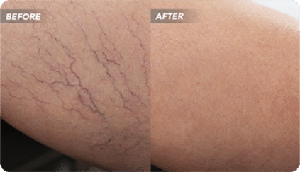 What Is the Cost of Vein Treatment New York?