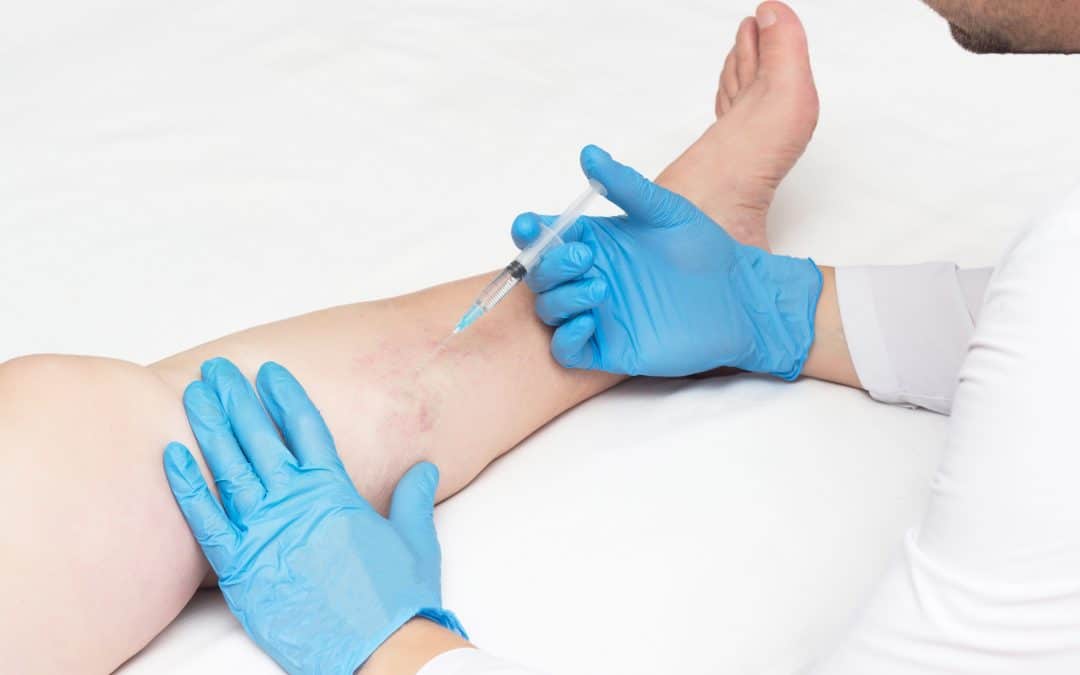 Top 7 Tips for Treatment from a Varicose Vein Doctor near Me Midtown