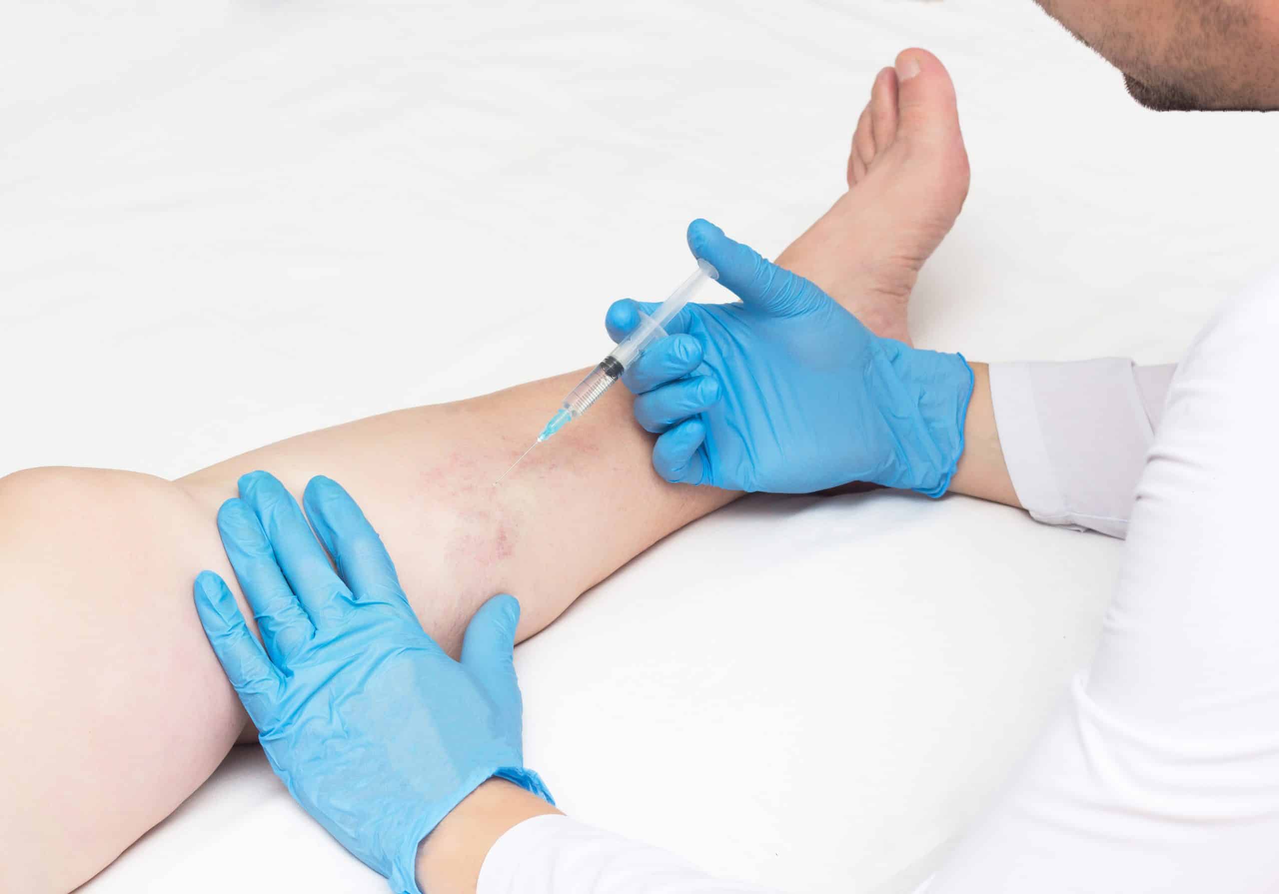book-appt-form-left-side-bg-mobile What is the process for vein treatment NYC if I have spider veins and venous insufficiency? We walk you through all of the steps from when you first identify spider veins or varicose veins, until you undergo treatment from a vein doctor.