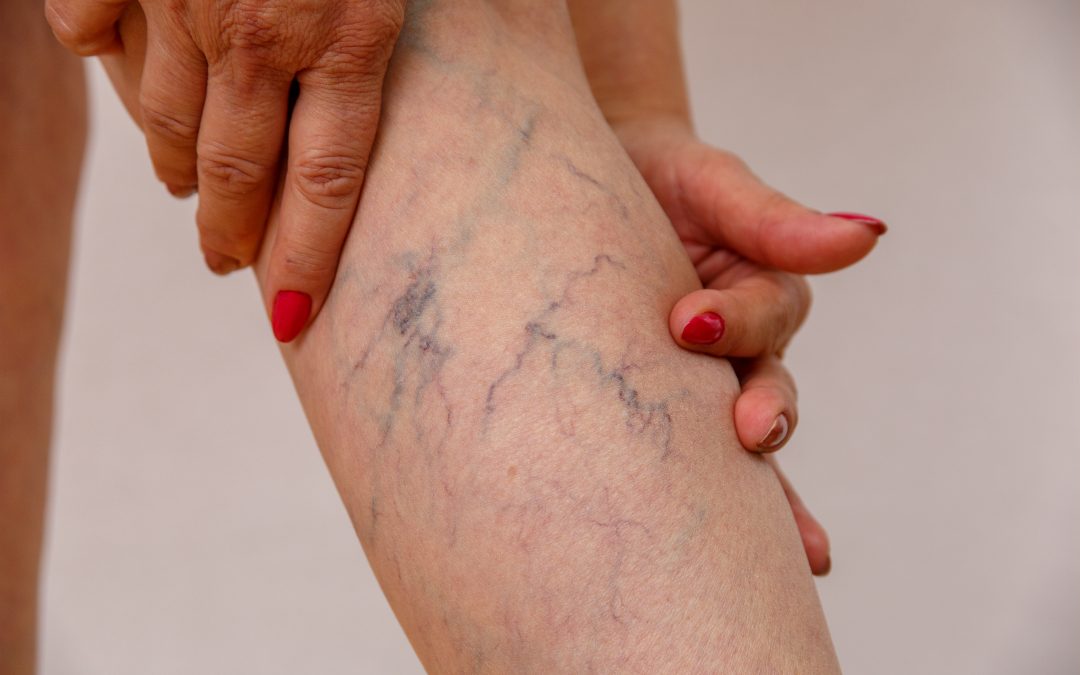 If I Have Varicose Veins, What Are My Options for Vein Treatment near Me Manhattan?