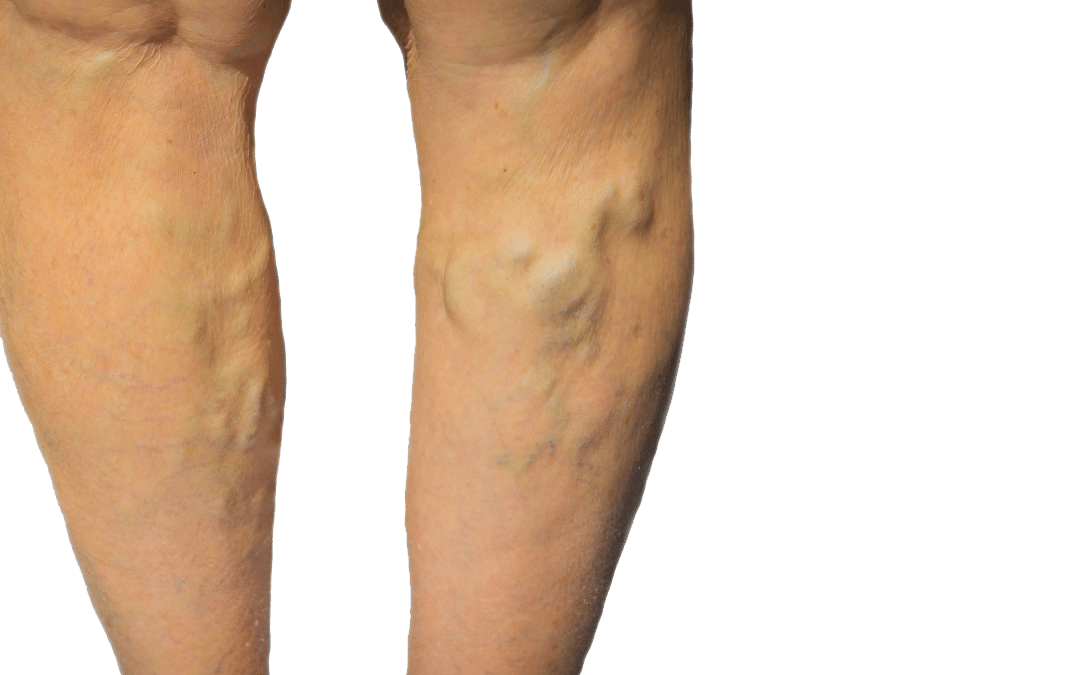 What Are the Methods in the Process for Vein Treatment NYC If I Have Spider Veins and Venous Insufficiency?