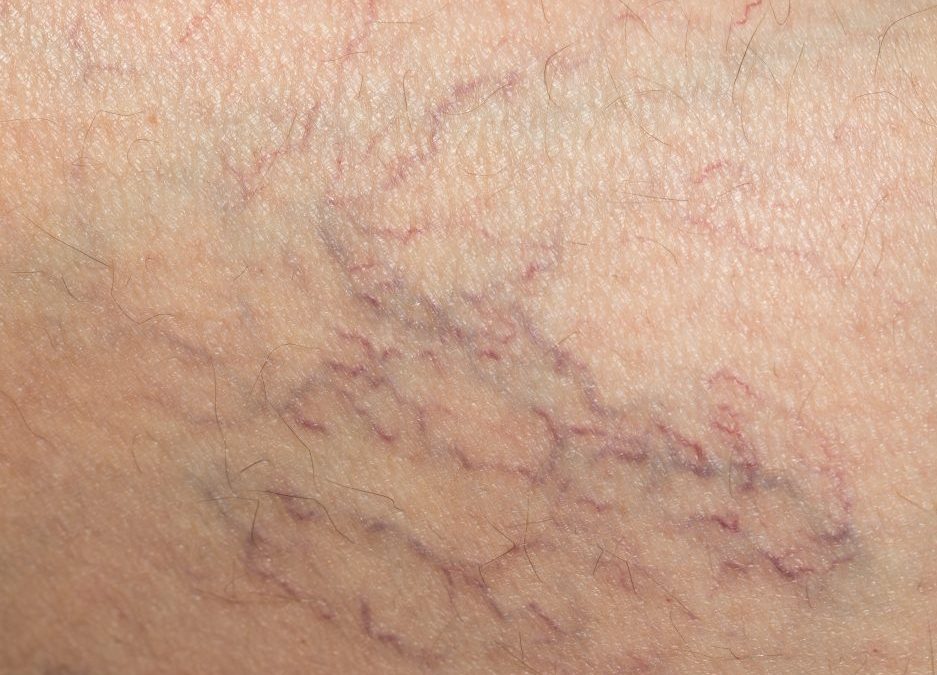 5 Dangers of Vein Disease from Vein Doctor Near Me NYC