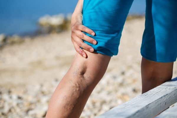 You probably know what varicose veins look like. But do you know who treats them? Here, we define how each type of varicose vein doctor in Manhattan treats veins.