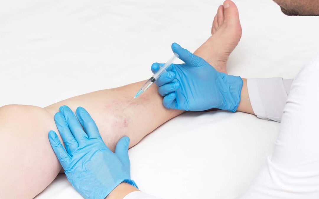 7 Reasons to Select a Vein Center in New York Carefully