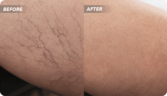 VTCBefore-After-12 (1) (1) What would happen if I let my varicose veins go untreated, or if I seek treatment from an unreputable clinic? Highly trained varicose vein doctors in NYC talk about five risks of not seeking treatment for varicose veins or getting treated in the wrong place.