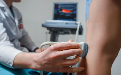 Radiofrequency Ablation (RFA) for Varicose Veins in Astoria